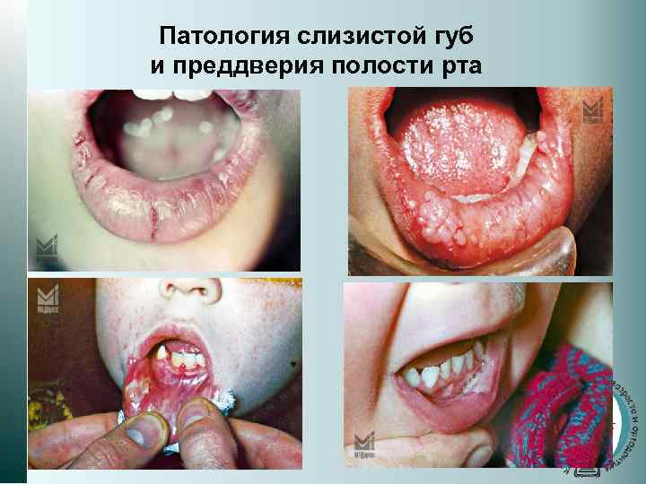 Патология слизистой губ и преддверия полости рта 