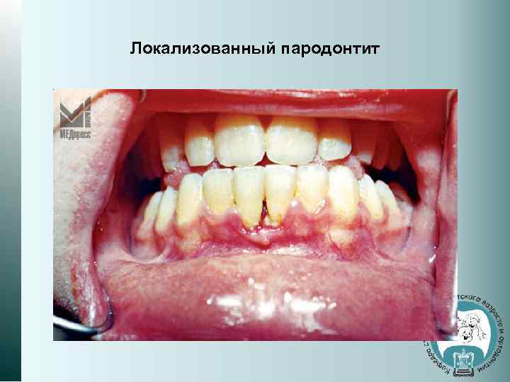 Локализованный пародонтит 