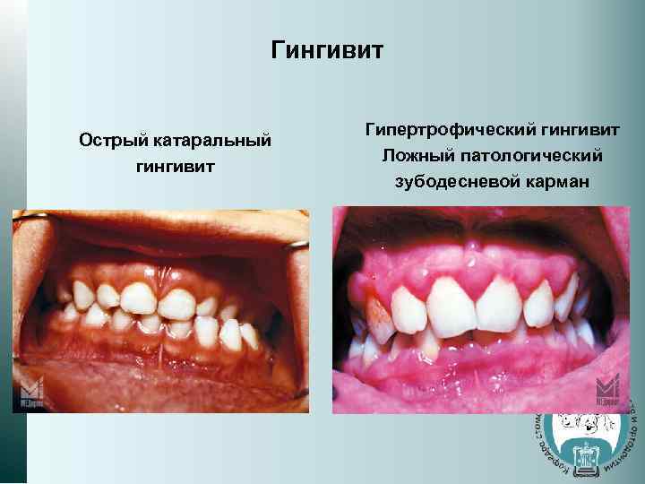 Гингивит Острый катаральный гингивит Гипертрофический гингивит Ложный патологический зубодесневой карман 