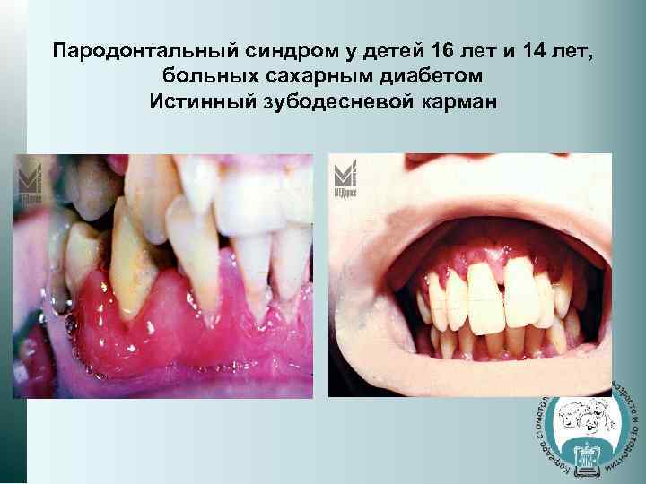 Пародонтальный синдром у детей 16 лет и 14 лет, больных сахарным диабетом Истинный зубодесневой