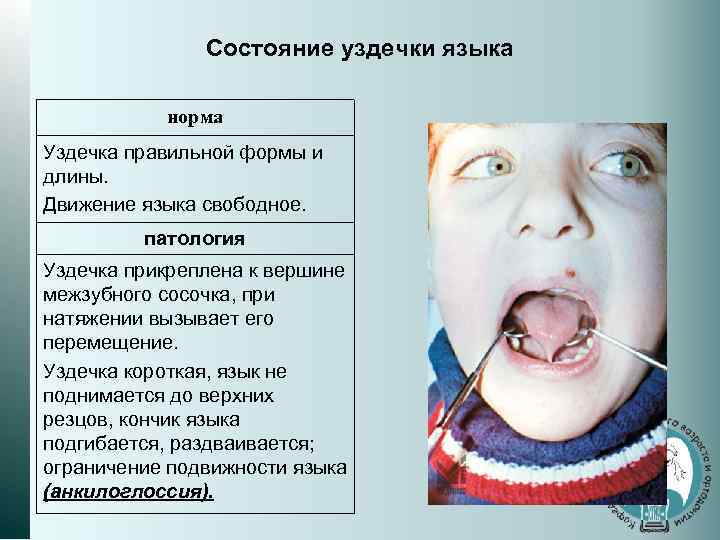 Состояние уздечки языка норма Уздечка правильной формы и длины. Движение языка свободное. патология Уздечка