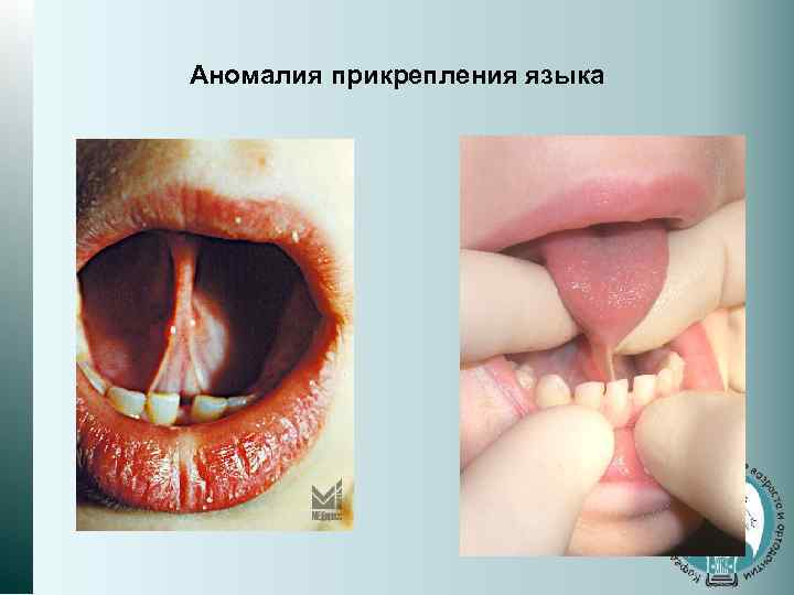 Аномалия прикрепления языка 