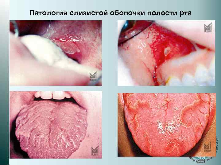 Патология слизистой оболочки полости рта 