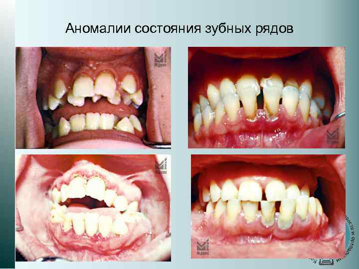 Кариес зубов картинки для детей