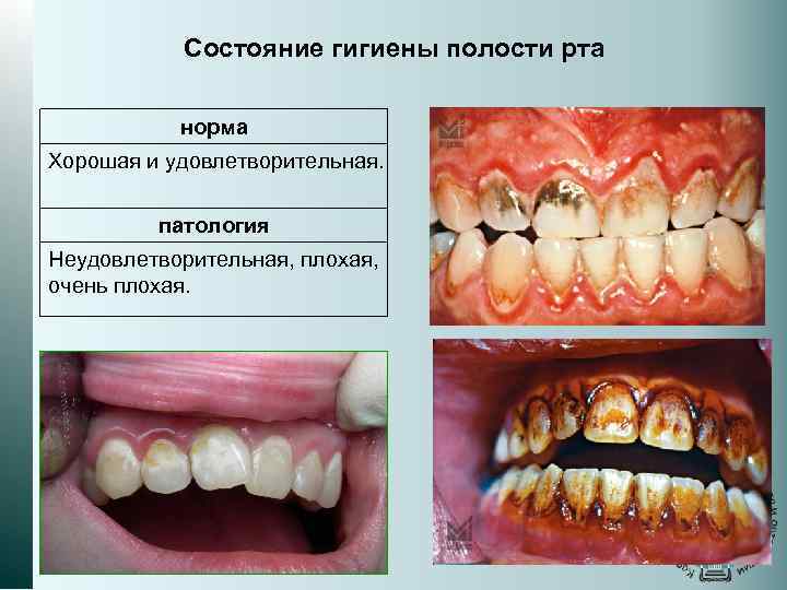 Состояние гигиены полости рта норма Хорошая и удовлетворительная. патология Неудовлетворительная, плохая, очень плохая. 