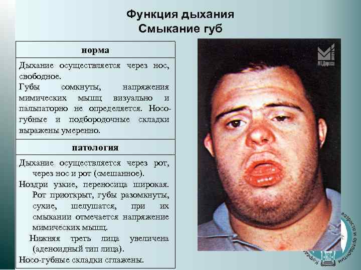 Функция дыхания Смыкание губ норма Дыхание осуществляется через нос, свободное. Губы сомкнуты, напряжения мимических