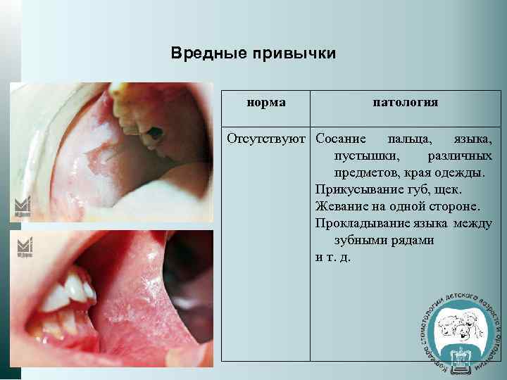 Вредные привычки норма патология Отсутствуют Сосание пальца, языка, пустышки, различных предметов, края одежды. Прикусывание