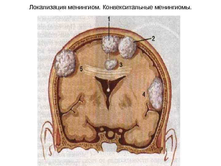 Что такое менингиома