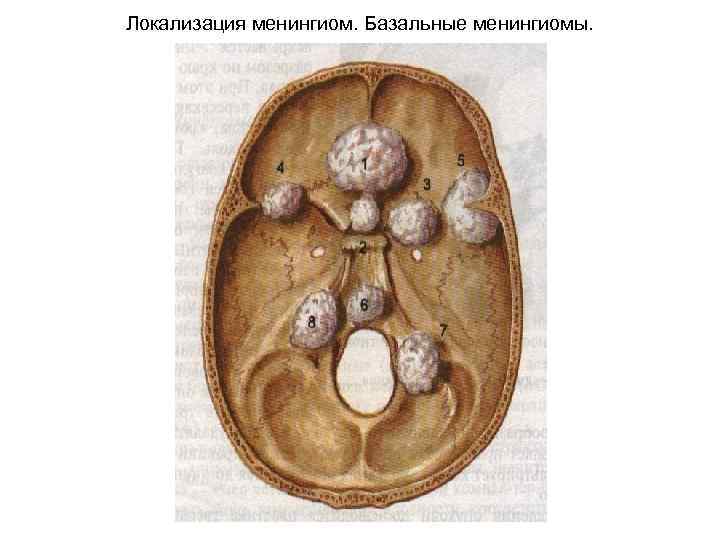 Локализация менингиом. Базальные менингиомы. 