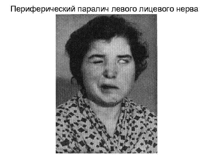 Периферический паралич левого лицевого нерва 