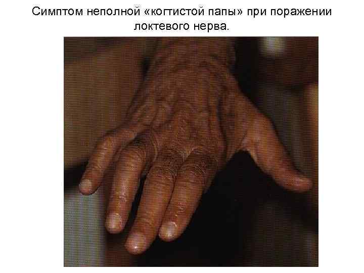 Симптом неполной «когтистой папы» при поражении локтевого нерва. 