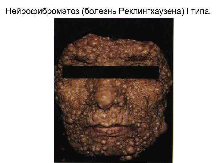 Нейрофиброматоз (болезнь Реклингхаузена) I типа. 