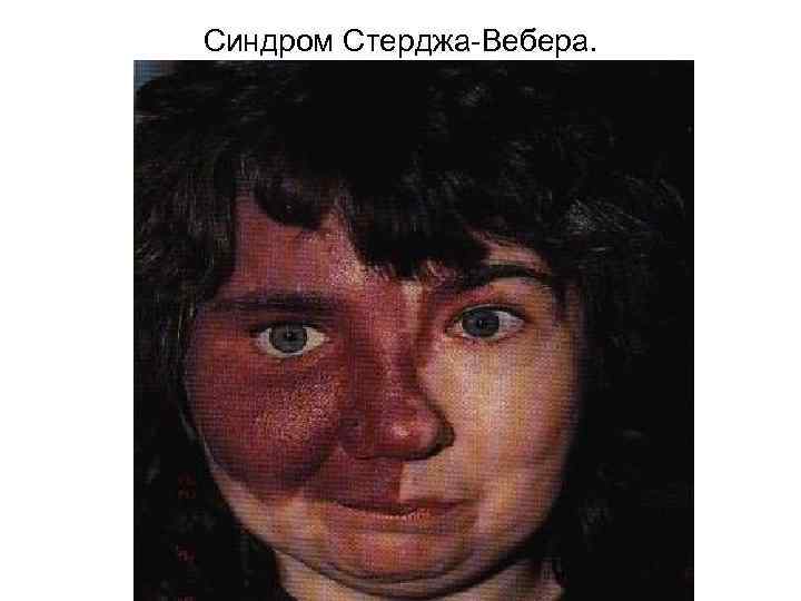 Синдром Стерджа Вебера. 