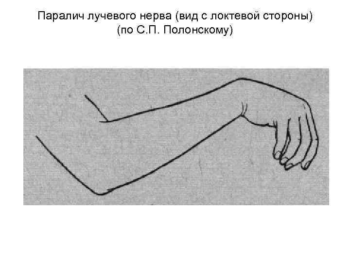 Паралич лучевого нерва (вид с локтевой стороны) (по С. П. Полонскому) 