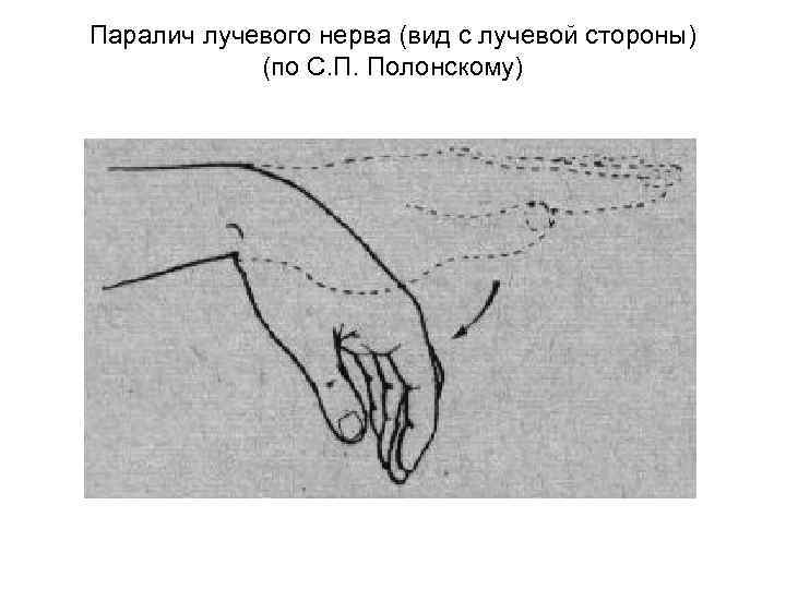 Паралич лучевого нерва (вид с лучевой стороны) (по С. П. Полонскому) 