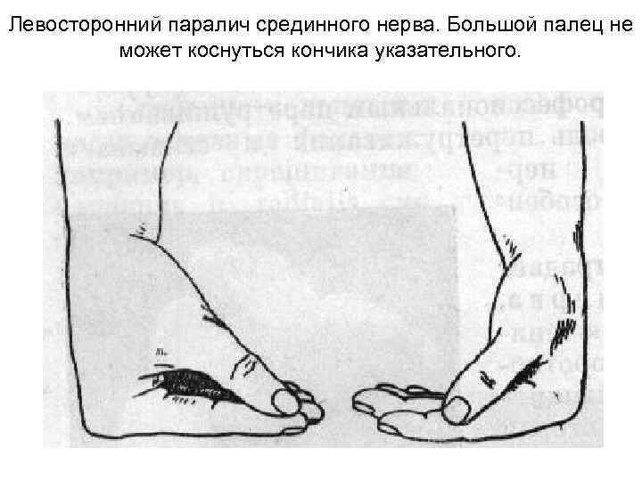 Левосторонний паралич срединного нерва. Большой палец не может коснуться кончика указательного. 