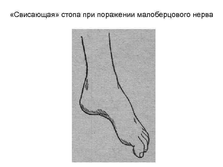  «Свисающая» стопа при поражении малоберцового нерва 