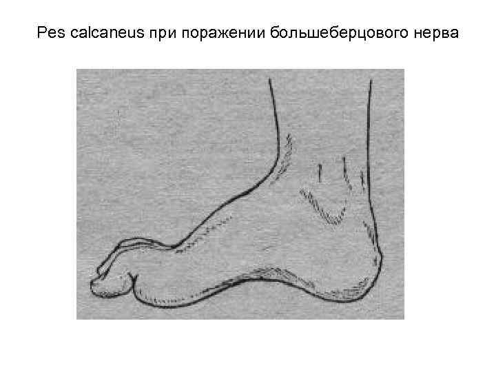 Pes calcaneus при поражении большеберцового нерва 