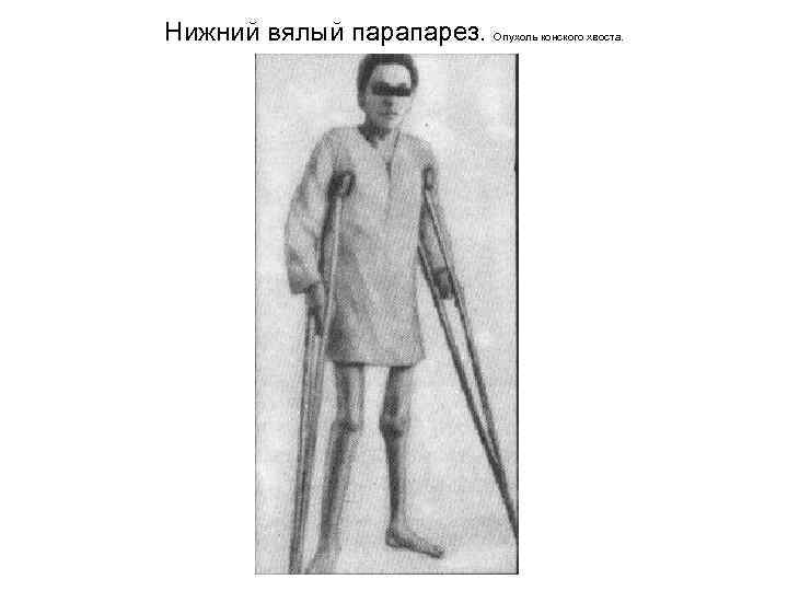 Нижний вялый парапарез. Опухоль конского хвоста. 