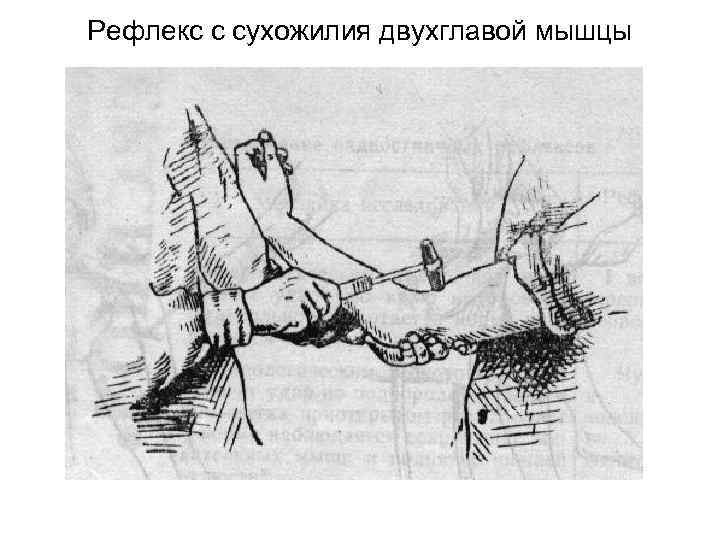 Рефлекс с сухожилия двухглавой мышцы 