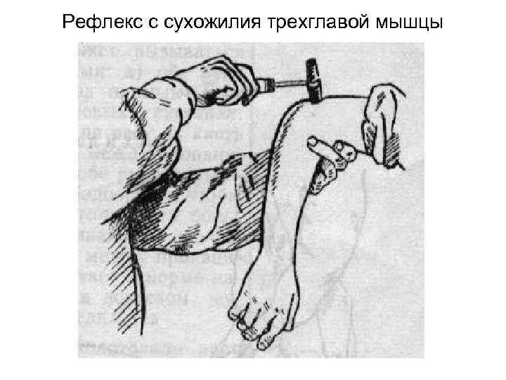 Рефлекс с сухожилия трехглавой мышцы 