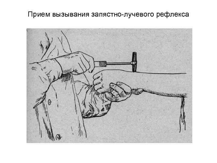 Прием вызывания запястно лучевого рефлекса 