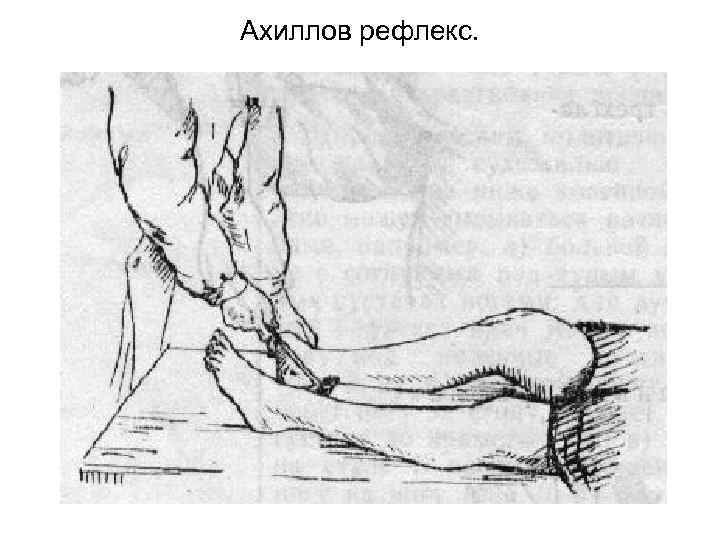Ахиллов рефлекс. 
