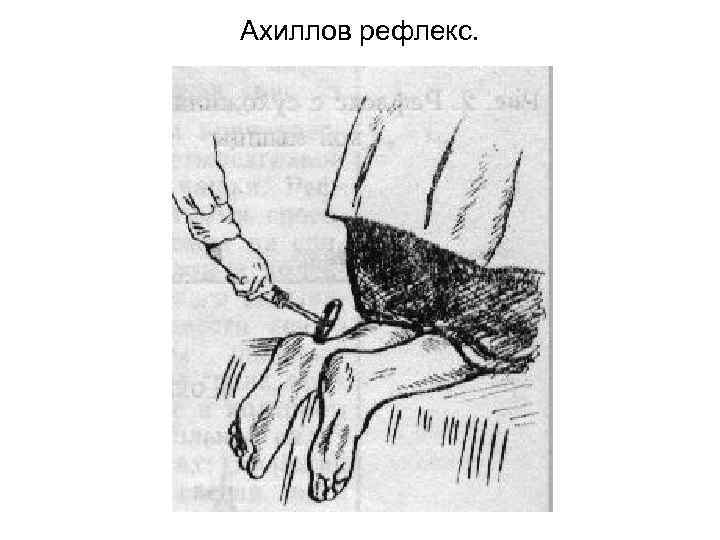 Ахиллов рефлекс. 