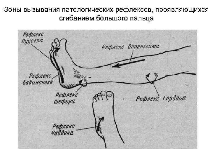 Зоны вызывания патологических рефлексов, проявляющихся сгибанием большого пальца 