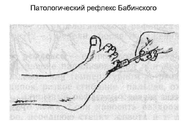 Патологический рефлекс Бабинского 