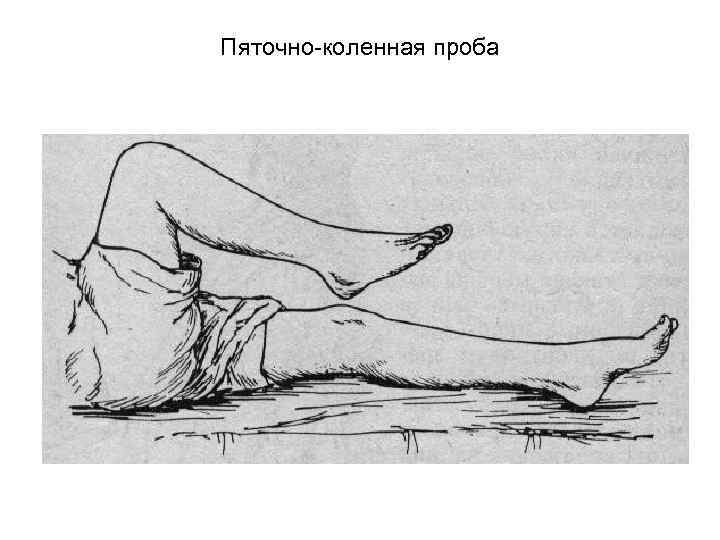 Пяточно коленная проба 