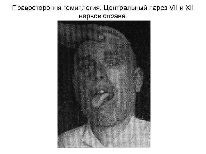 Правостороння гемиплегия. Центральный парез VII и XII нервов справа. 