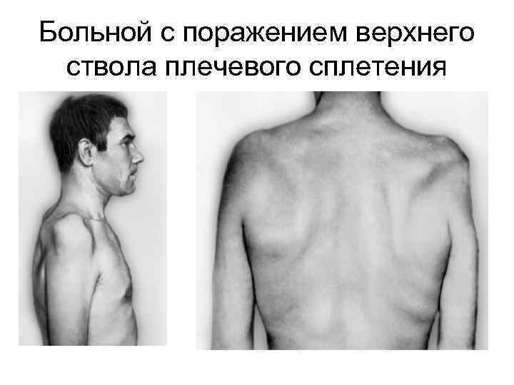 Больной с поражением верхнего ствола плечевого сплетения 