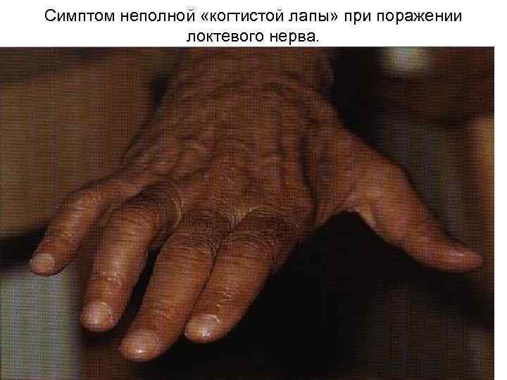 Симптом неполной «когтистой лапы» при поражении локтевого нерва. 