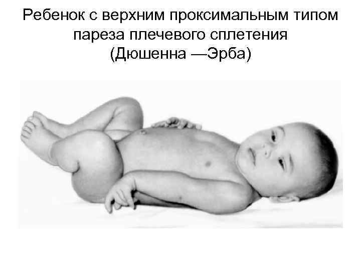 Ребенок с верхним проксимальным типом пареза плечевого сплетения (Дюшенна —Эрба) 