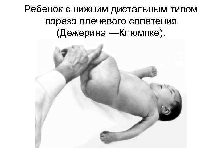 Ребенок с нижним дистальным типом пареза плечевого сплетения (Дежерина —Клюмпке). 