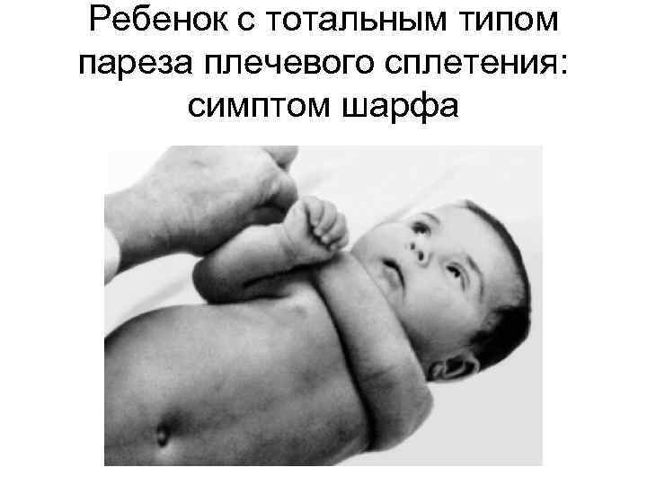 Ребенок с тотальным типом пареза плечевого сплетения: симптом шарфа 