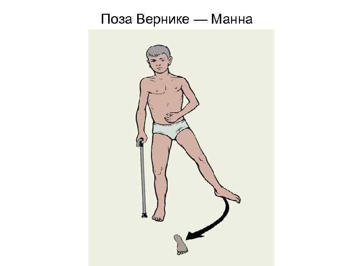 Поза Вернике — Манна 
