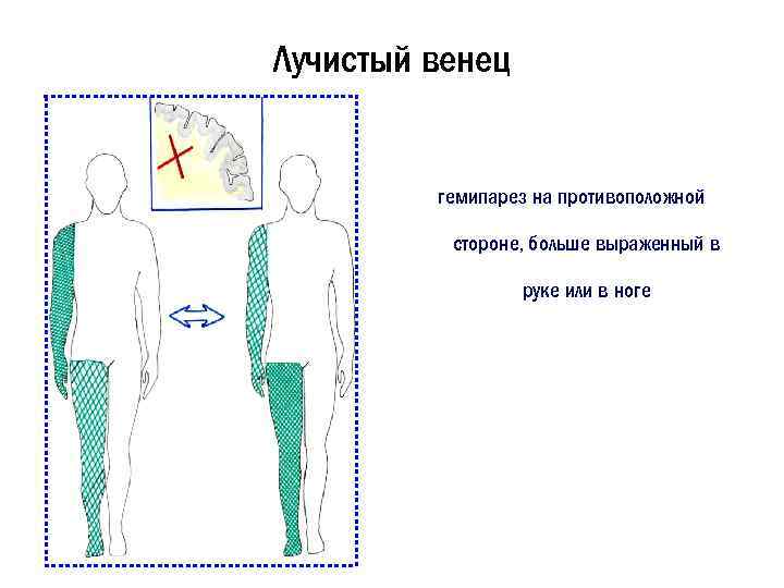 Лучистый венец гемипарез на противоположной стороне, больше выраженный в руке или в ноге 