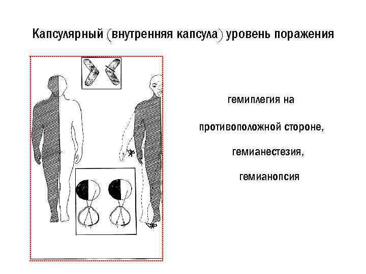 Внутреннее поражение. Синдром поражения внутренней капсулы (капсулярный. Синдром поражения внутренней капсулы неврология. Синдромы поражения правой внутренней капсулы. Синдром поражения внутренней капсулы головного мозга.