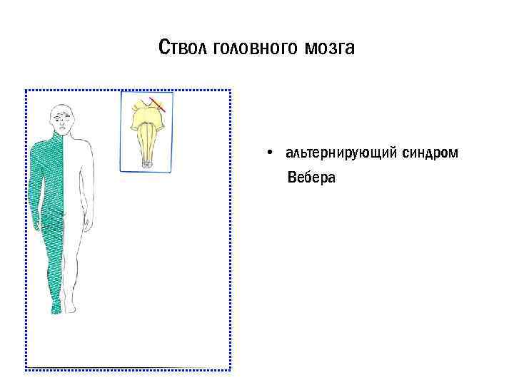 Ствол головного мозга • альтернирующий синдром Вебера 