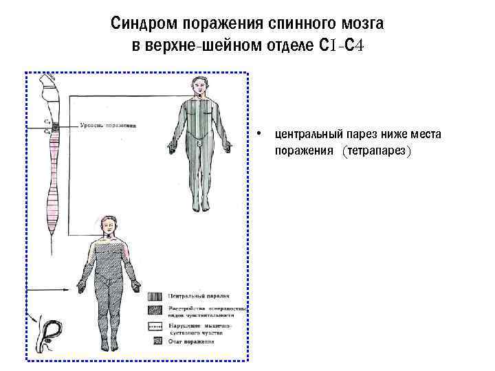Синдром поражения спинного мозга в верхне-шейном отделе С 1 -С 4 • центральный парез