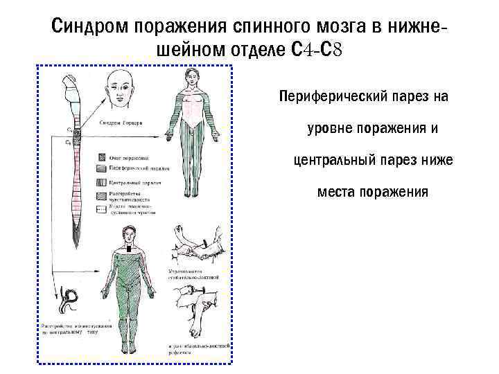 Синдром поражения спинного мозга в нижнешейном отделе С 4 -С 8 Периферический парез на