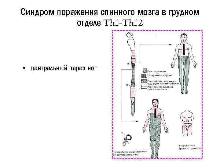 Синдром поражения спинного мозга в грудном отделе Th 1 -Th 12 • центральный парез