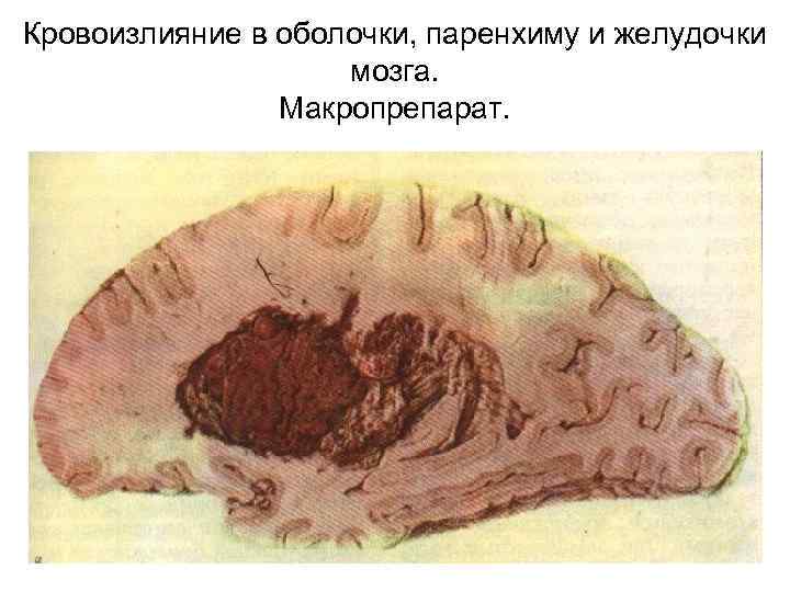 Кровоизлияние в оболочки, паренхиму и желудочки мозга. Макропрепарат. 