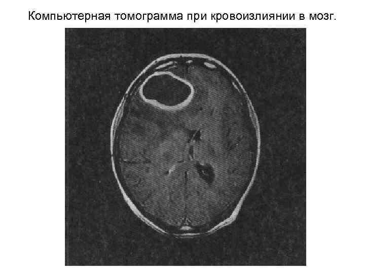 Компьютерная томограмма при кровоизлиянии в мозг. 