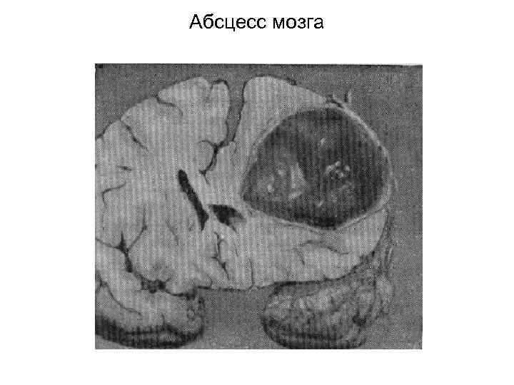 Абсцесс мозга 
