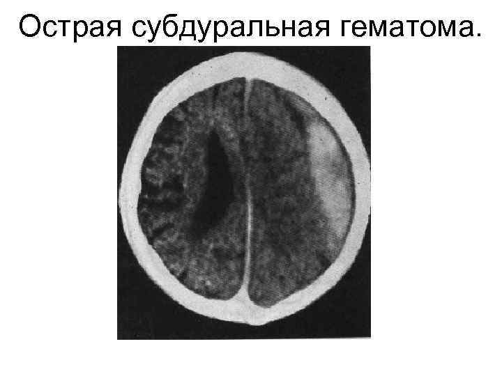 Острая субдуральная гематома. 