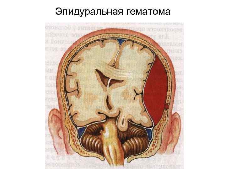 Эпидуральная гематома фото