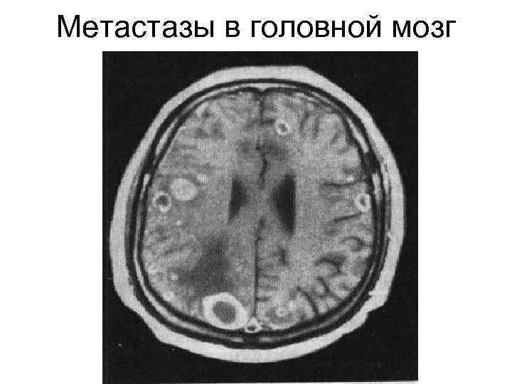 Метастазы в головной мозг 